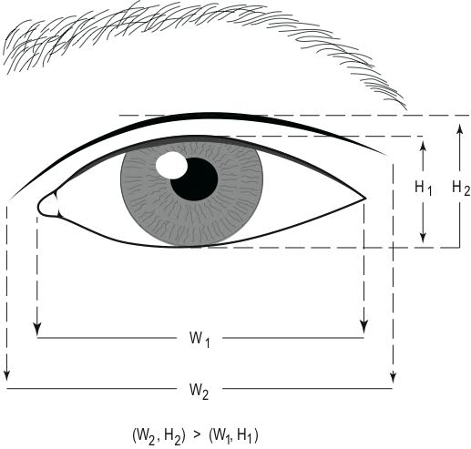 double eyelid crease diagram